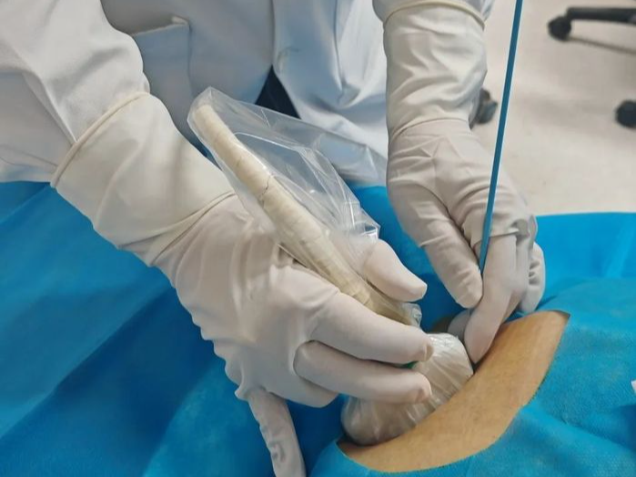 化脓性胆囊炎几近休克，却无法进行外科手术后，他们这样做~