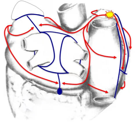 延安大学咸阳医院完成2例瓣膜手术同期行房颤外科射频消融术