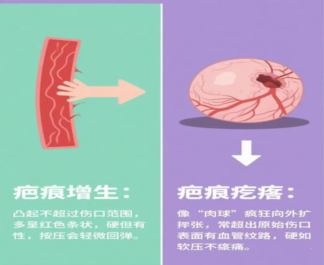 医学科普丨从瘢痕到无痕 别让瘢痕“留遗憾”！