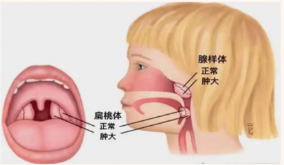 呼噜、张口呼吸，割还是不割~医生：这些孩子别再等！